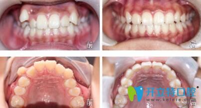 南京美萊矯正牙齒如何？美萊虎牙矯正真人案例效果對(duì)比圖公布