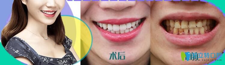 瓷貼面做了后悔死了，后悔沒有早點(diǎn)選擇華美牙科修復(fù)我的四環(huán)素牙