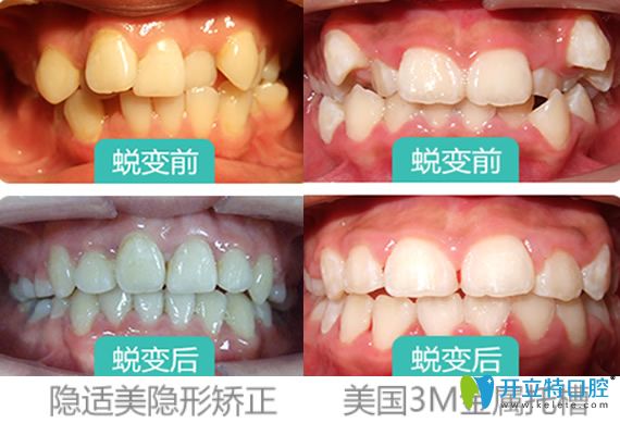 西安牙齒矯正哪家好？看西安雁塔惟真口腔隱適美矯正+金屬托槽矯正案例