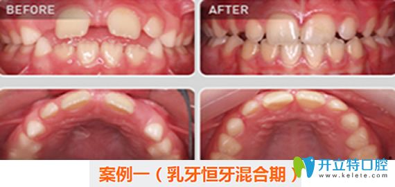 西安惟真口腔兒童牙齒矯正案例對比圖
