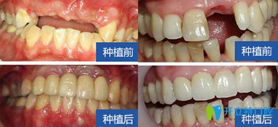 西安雁塔惟真口腔怎么樣？百萬真實(shí)案例，彰顯種植優(yōu)勢