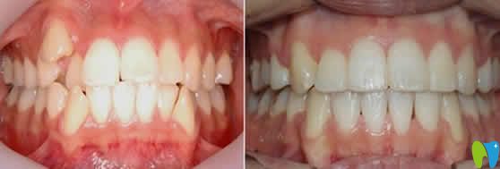 天津德倍爾口腔牙齒矯正前后對(duì)比圖