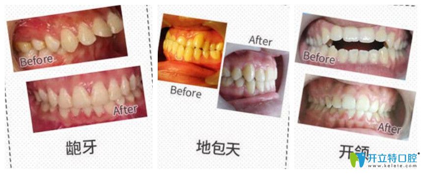 東莞利爾口腔好不好？牙齒矯正案例效果對(duì)比圖來(lái)驗(yàn)證