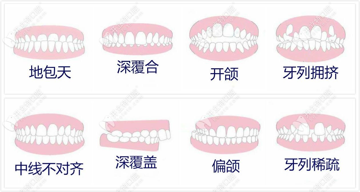 牙齒矯正適應癥