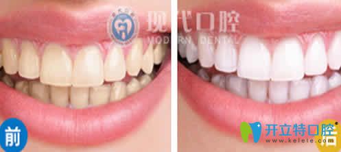 寧波現(xiàn)代口腔牙齒美白前后對(duì)比圖