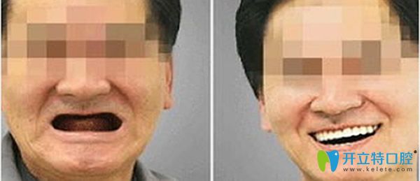 全口牙缺失種植牙案例
