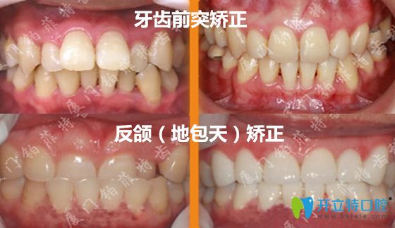 廈門鉑菲特口腔怎么樣？看牙齒矯正案例前后對比效果圖