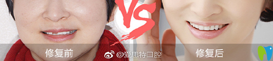 在愛思特口腔進行進口全瓷牙美學(xué)修復(fù)案例前后效果對比圖