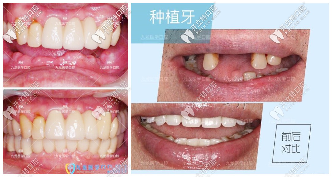 珠?？诒玫难揽漆t(yī)院種牙案例
