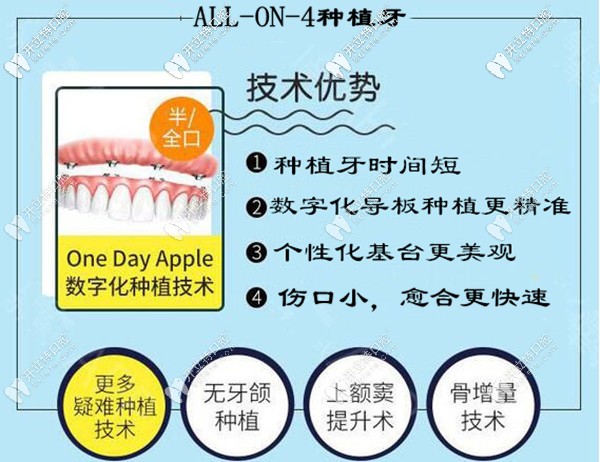 ?？诙c(diǎn)口腔allon4全口半口種植牙技術(shù)