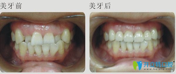 大連全好口腔牙齒矯正案例