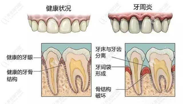 長春傳陽牙周疾病、根管治療