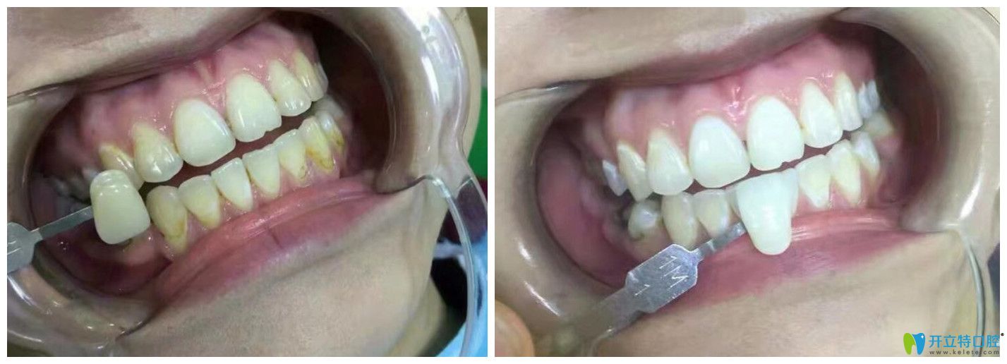 哈爾濱雅樂(lè)口腔牙齒冷光美白案例