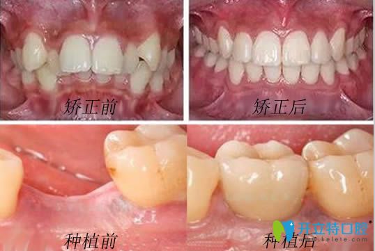 哈爾濱瑞益口腔牙齒正畸和種植牙案例效果對比圖