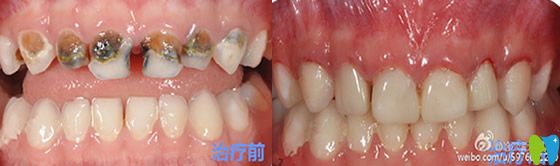 哈爾濱大象口腔乳牙預(yù)成冠治療術(shù)前術(shù)后對比案例