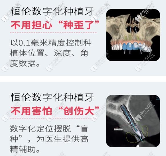 石家莊恒倫口腔數(shù)字化種植牙技術(shù)