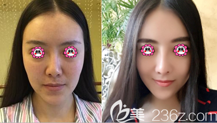 北京中日友好醫(yī)院薛志強耳軟骨復合隆鼻案例