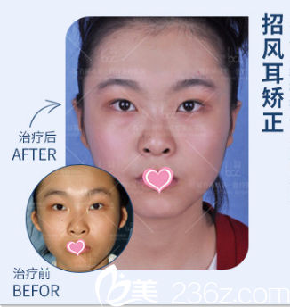 北京聯(lián)合麗格醫(yī)療美容醫(yī)院耳修復案例