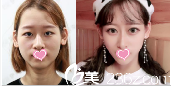 北京伊美爾切開雙眼皮案例