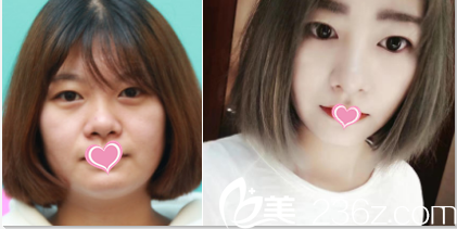 北京伊美爾耳軟骨復(fù)合隆鼻案例