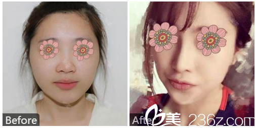 廣東藥科大學(xué)附屬醫(yī)院隆鼻做的好不好？李平隆鼻案例分享