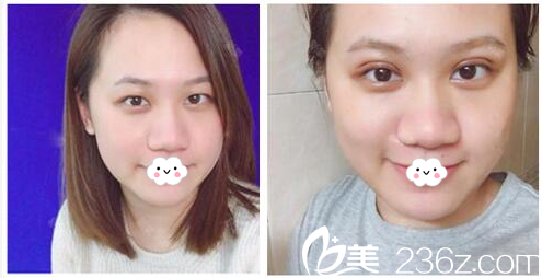 廣東藥科大學(xué)附屬醫(yī)院割雙眼皮怎么樣？全切雙眼皮案例對比圖