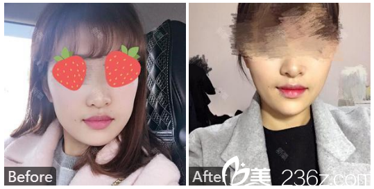 廣州中山大學附屬第三醫(yī)院朱蕾玻尿酸隆下巴和瘦臉案例