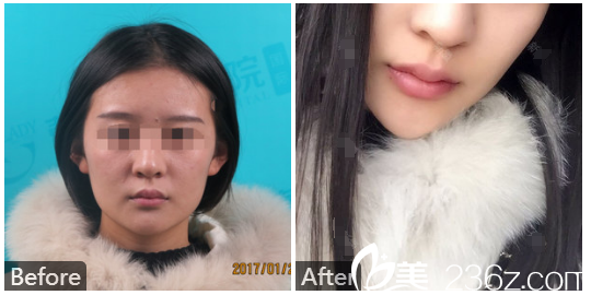 廣州中山大學附屬第三醫(yī)院朱蕾玻尿酸豐唇案例
