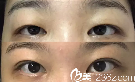 2廣州中山大學附屬第三醫(yī)院割雙眼皮怎么樣？看顏玲雙眼皮案例