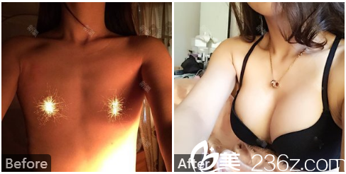 羅盛康教授隆胸效果好嗎？看假體隆胸案例圖
