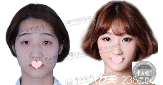 廣州中山醫(yī)科大學(xué)家庭醫(yī)生整形醫(yī)院黃廣香切開雙眼皮案例