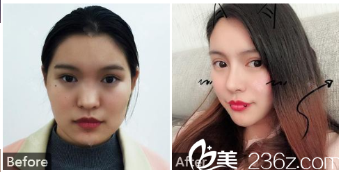 廣州中山醫(yī)科大學(xué)家庭醫(yī)生整形美容醫(yī)院劉冰隆鼻和脂肪填充案例