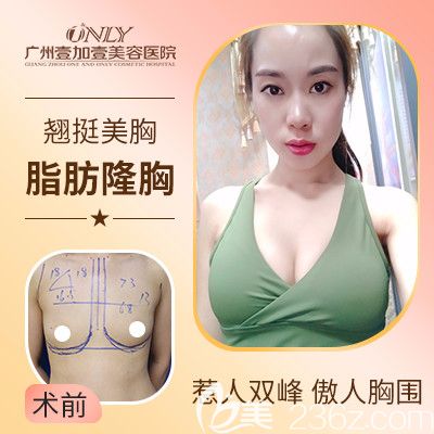 廣州壹加壹項(xiàng)美蓮做的自體脂肪隆胸案例