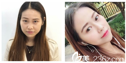 廣州壹加壹整形美容醫(yī)院項(xiàng)美蓮雙眼皮案例對(duì)比圖