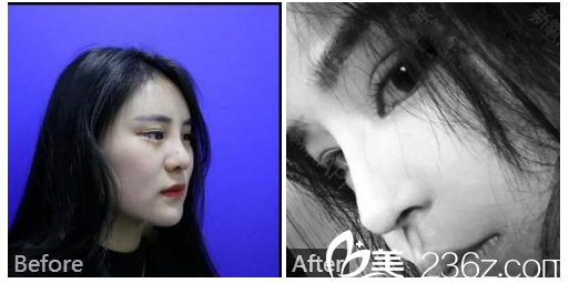 廣州壹加壹整形美容醫(yī)院項(xiàng)美蓮雙眼皮隆鼻案例