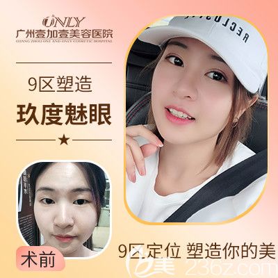 廣州壹加壹項(xiàng)美蓮玖度美眼雙眼皮案例