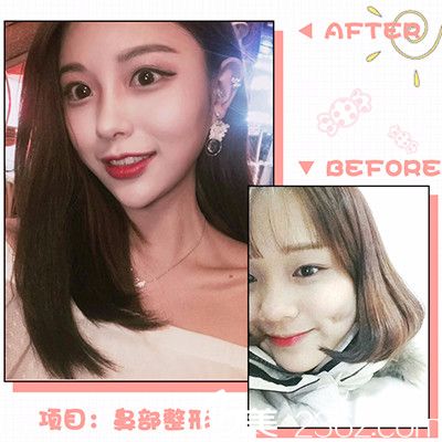 廣州美貝爾醫(yī)療美容整形醫(yī)院鼻綜合隆鼻案例對比圖