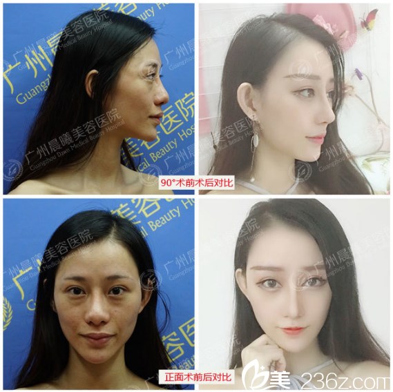 廣州晨曦廖軼平醫(yī)生鼻綜合隆鼻前后對比圖