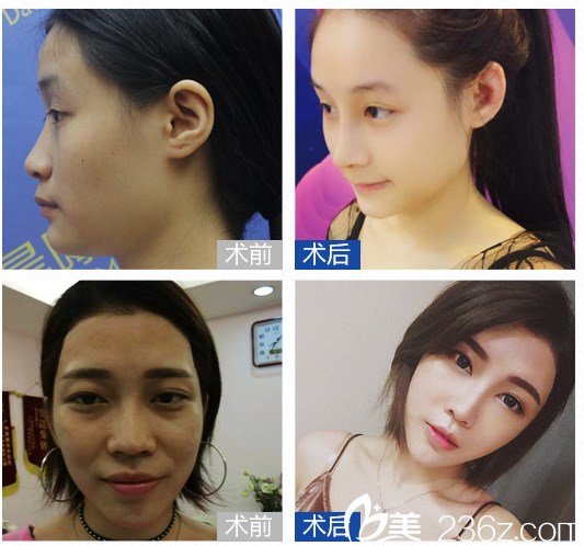 廣州晨曦陳珂醫(yī)生隆鼻案例對比圖