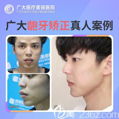 廣州正頜手術(shù)哪家醫(yī)院好？請看廣州廣大整形醫(yī)院何錦泉正頜手術(shù)案例