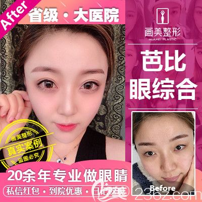廣東畫美張勇做的全切雙眼皮