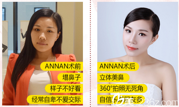廣東畫美整形醫(yī)院張勇隆鼻案例