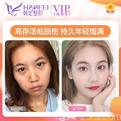 廣東廣州畫美曾繁茂做的全臉自體脂肪填充案例