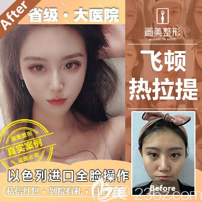 廣東畫美熱拉提全臉治療案例