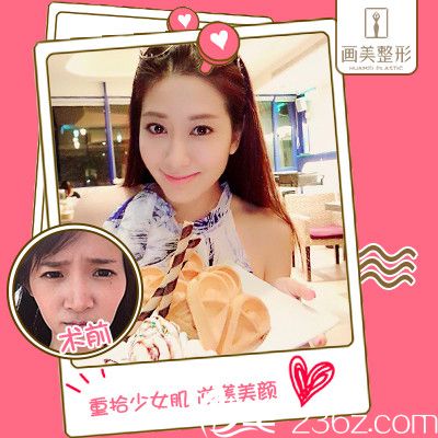 廣東畫美姜友定面部脂肪填充案例