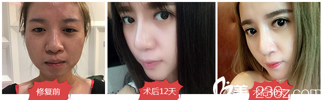 廣東畫美姜友定雙眼皮失敗修復(fù)案例