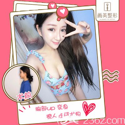 廣東畫美牟北平假體隆胸案例
