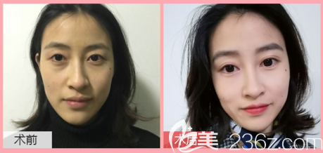 廣東畫美石林醫(yī)生做雙眼皮怎么樣