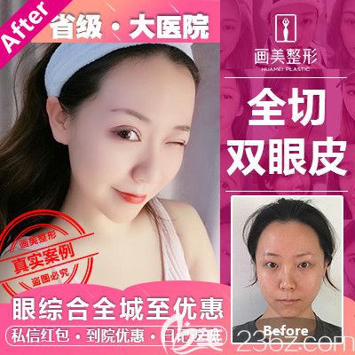 廣東畫美牟北平做的雙眼皮案例