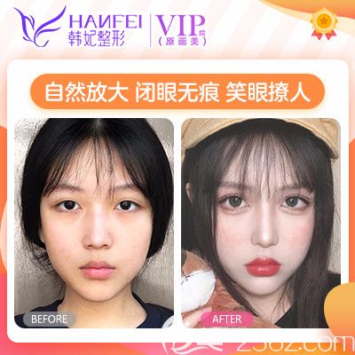廣東廣州畫美曾繁茂做的雙眼皮案例 廣東廣州畫美曾繁茂做的雙眼皮案例